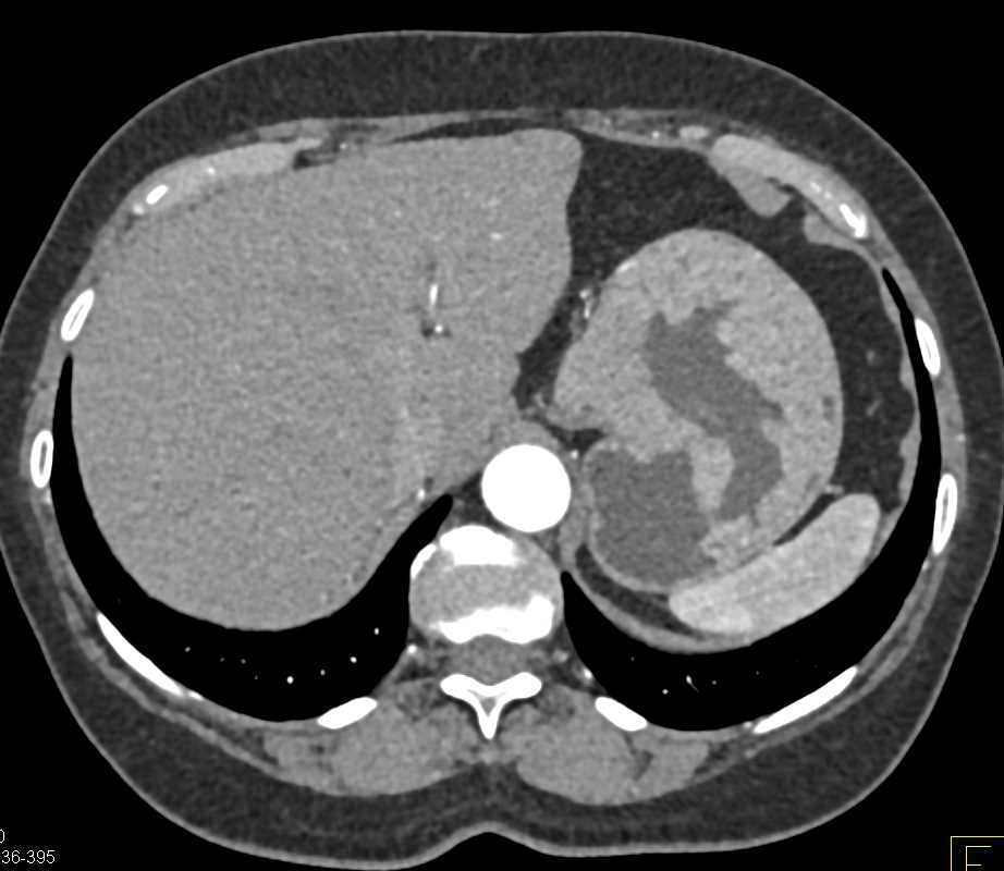 Gastric Lymphoma - CTisus CT Scan