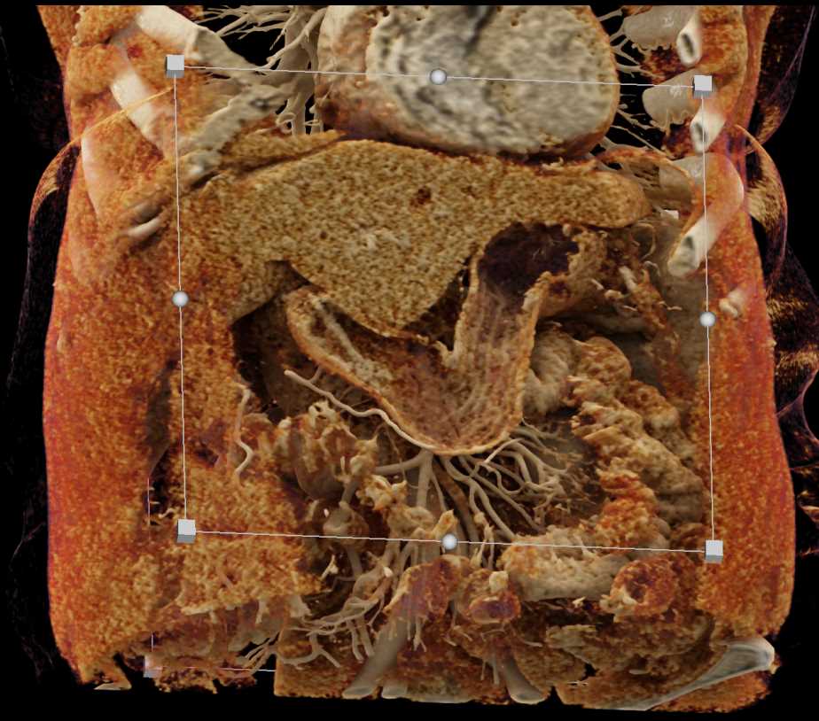 Subtle Gastric Adenocarcinoma - CTisus CT Scan