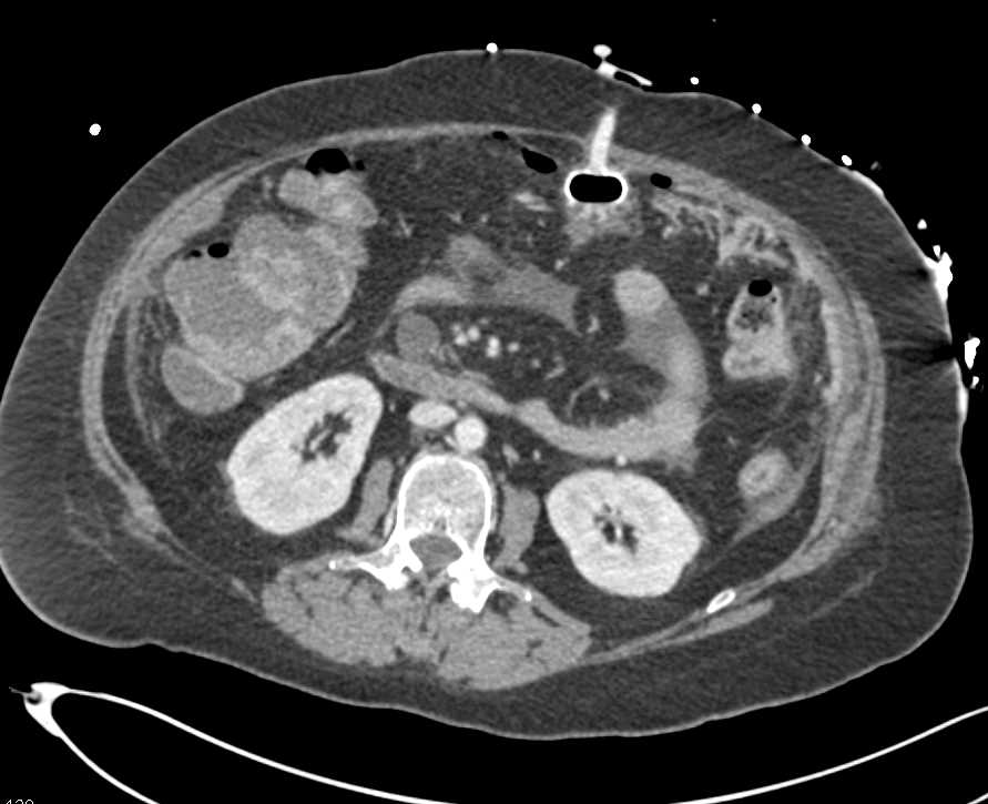 G-Tube Needs to be Repositioned - CTisus CT Scan