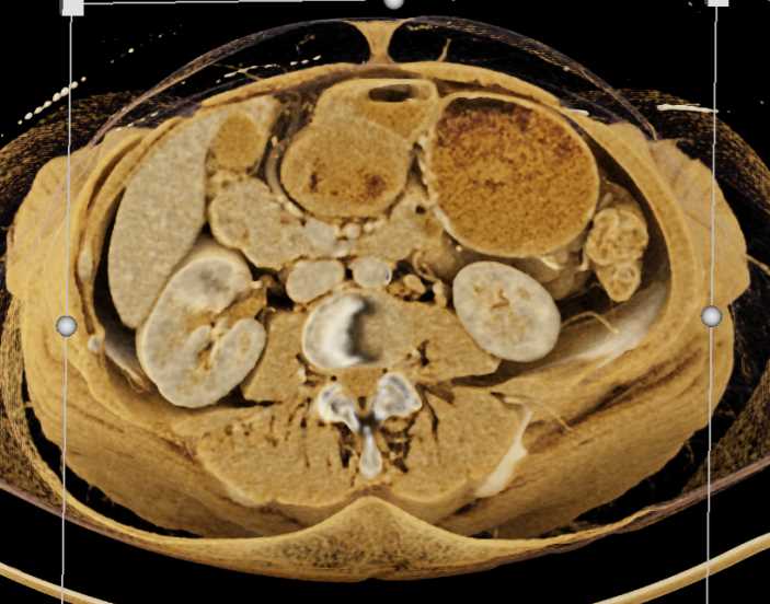 Thickened Gastric Folds - CTisus CT Scan