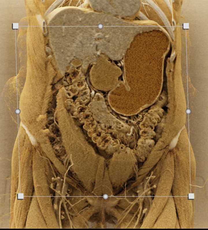 GIST Tumor off Gastric Antrum - CTisus CT Scan