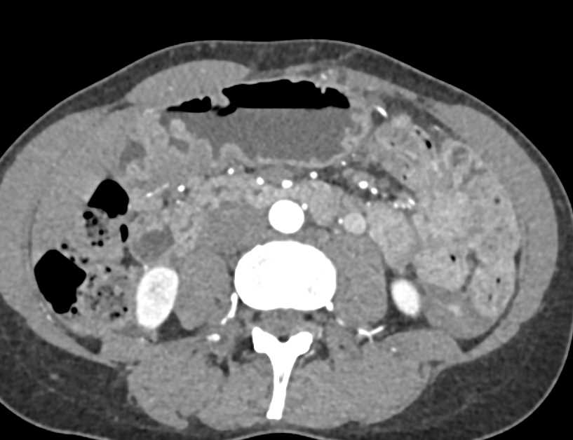 Carcinoma Gastric Antrum - CTisus CT Scan