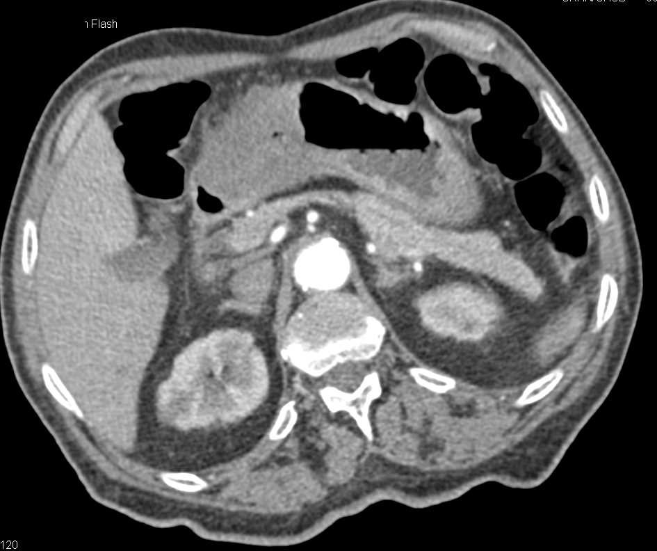 Infiltrating Adenocarcinoma of the Stomach - CTisus CT Scan