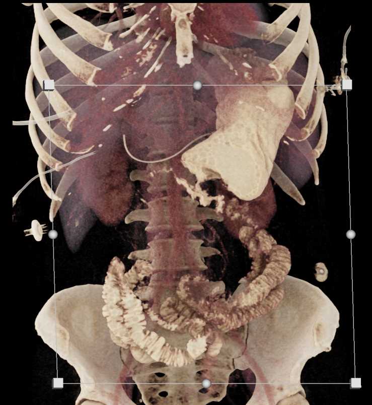 Gastrojejunsotomy Anastomosis - CTisus CT Scan