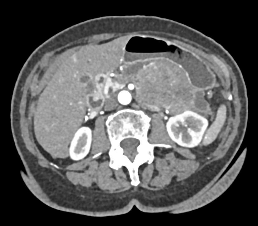 Gastric GIST Tumor - CTisus CT Scan