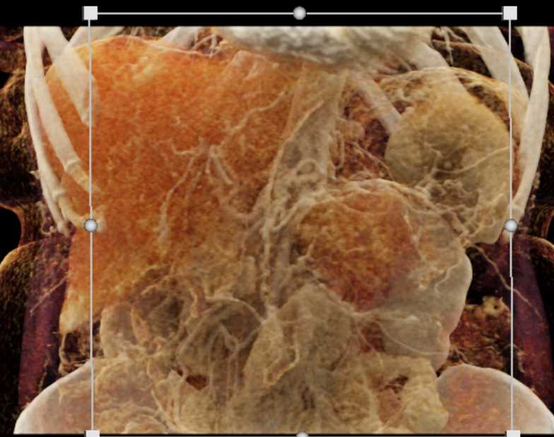 Gastric GIST Tumor - CTisus CT Scan