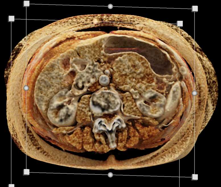 Gastric GIST Tumor - CTisus CT Scan