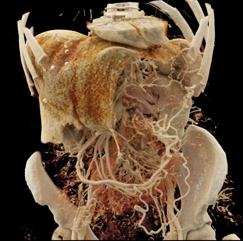 Gastric GIST Tumor with Vascular Mapping - CTisus CT Scan