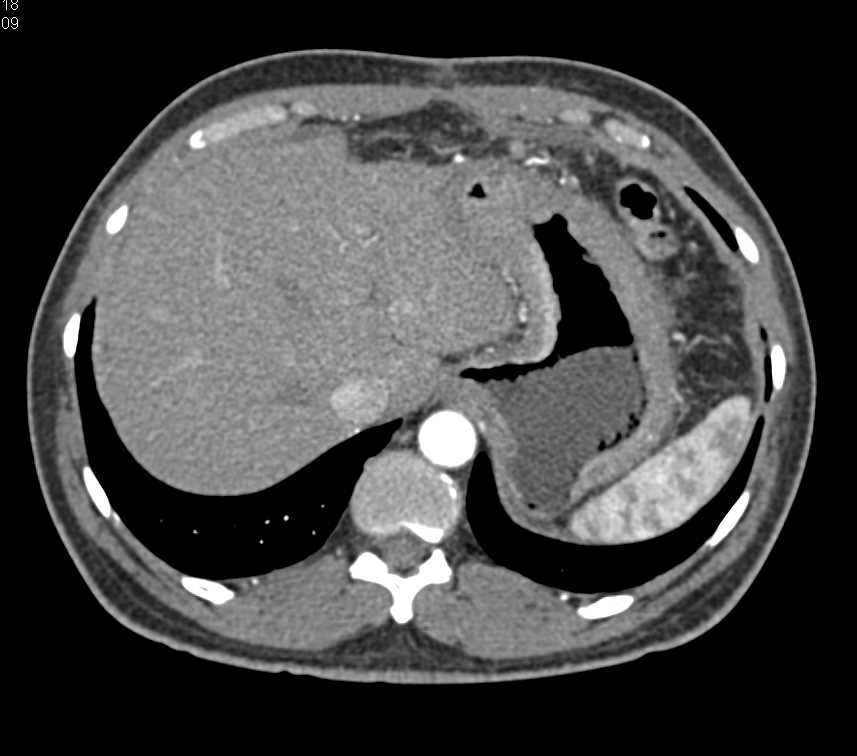 Infiltrating Gastric Adenocarcinoma - CTisus CT Scan