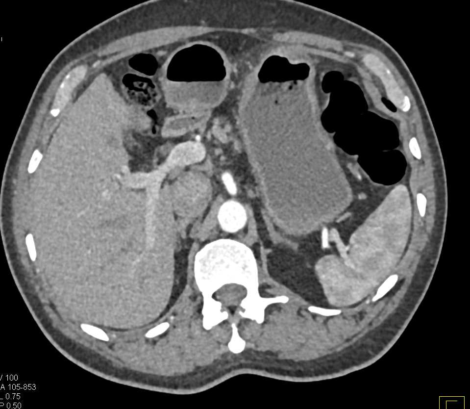 Gastric Adenocarcinoma - CTisus CT Scan