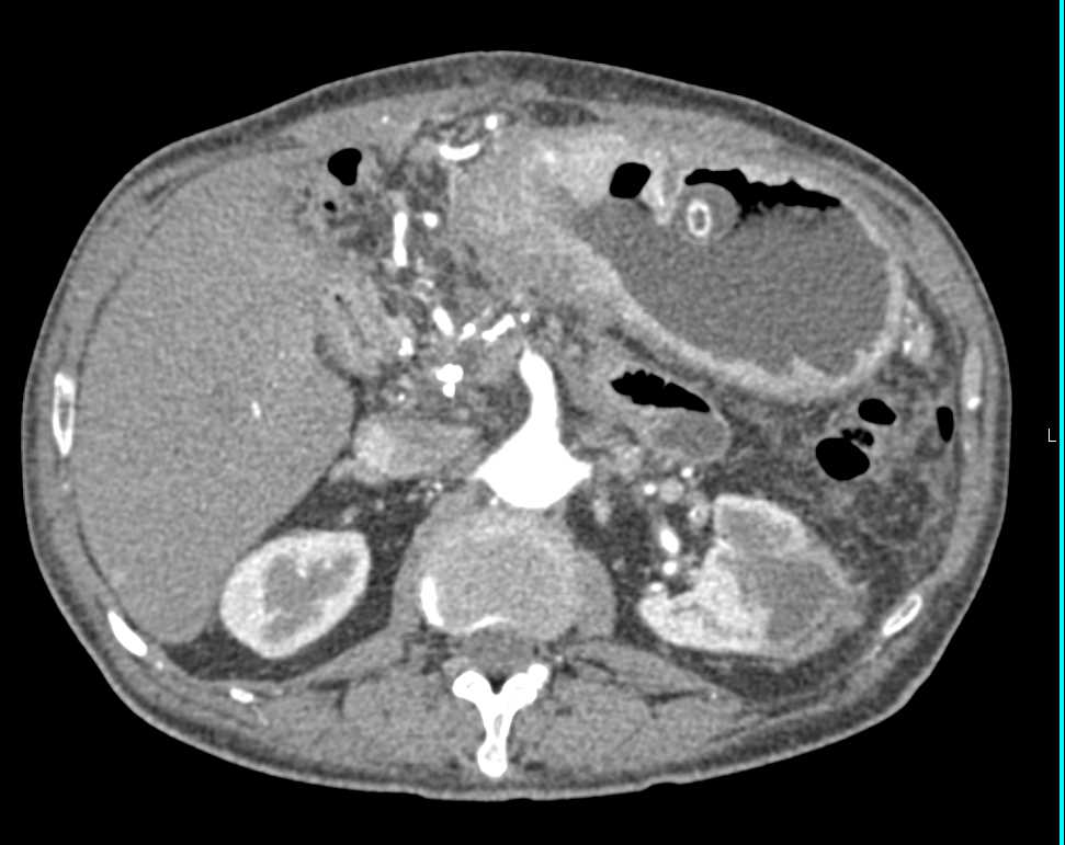 Gastric Antral Carcinoma - CTisus CT Scan