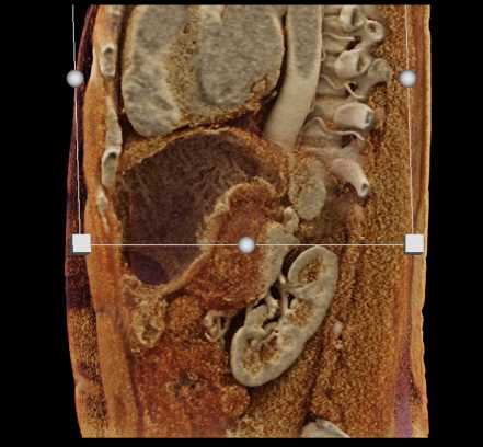 Gastric GIST Tumor - CTisus CT Scan