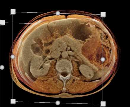 Gastric GIST Tumor - CTisus CT Scan