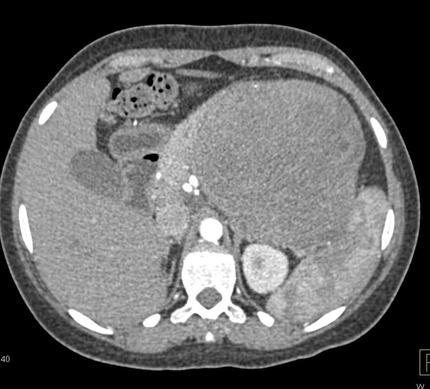 Gastric GIST Tumor - CTisus CT Scan