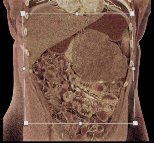 Gastric GIST Tumor - CTisus CT Scan