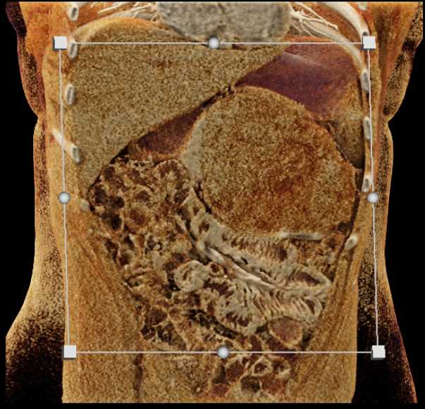 Gastric GIST Tumor - CTisus CT Scan