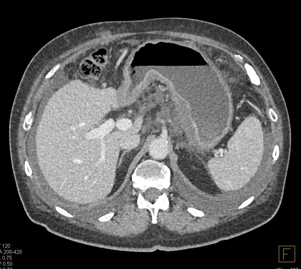 Gastric Cancer with Carcinomatosis - CTisus CT Scan