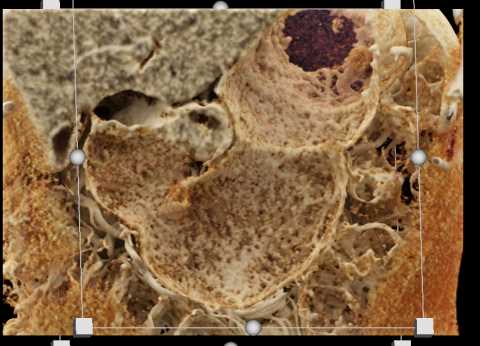 Cinematic Rendering of Gastric Folds - CTisus CT Scan