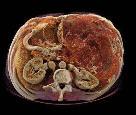 Ulcerating Gastric GIST Tumor - CTisus CT Scan