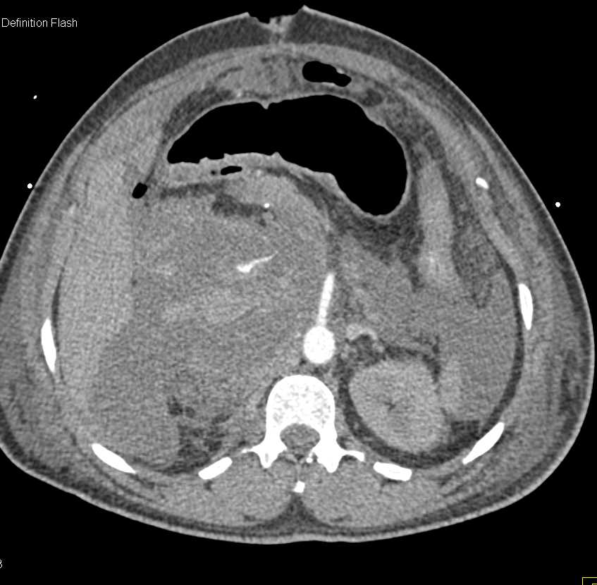 Gastric Adenocarcinoma with Carcinomatosis - CTisus CT Scan
