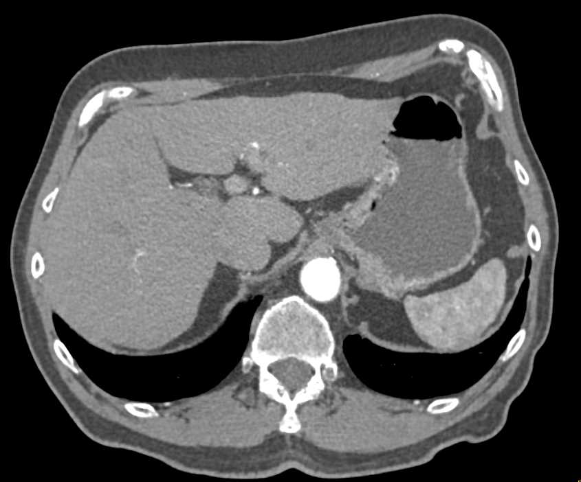 Carcinoma Gastric Fundus - CTisus CT Scan