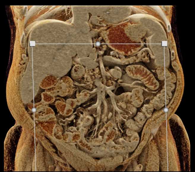 Gastric GIST Tumor - CTisus CT Scan