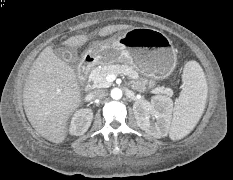 Perforated Gastric Ulcer - CTisus CT Scan