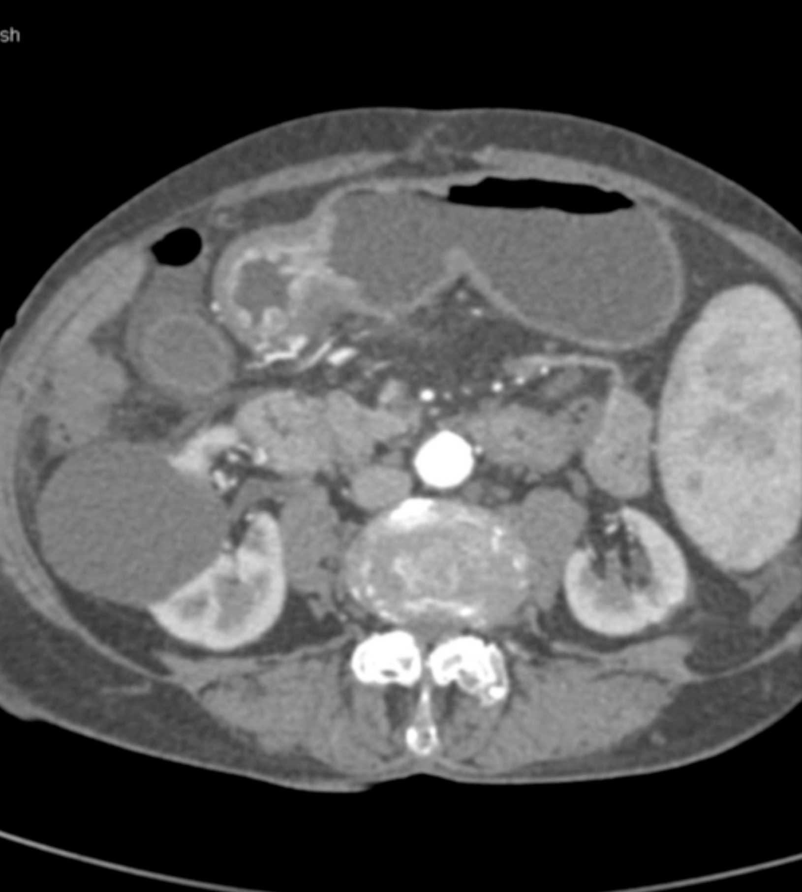 Vascular Ectasia in the Gastric Antrum - CTisus CT Scan