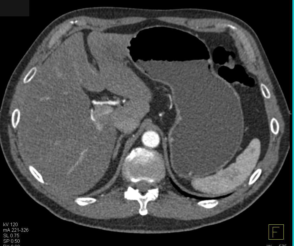 Gastritis in the Antrum - CTisus CT Scan