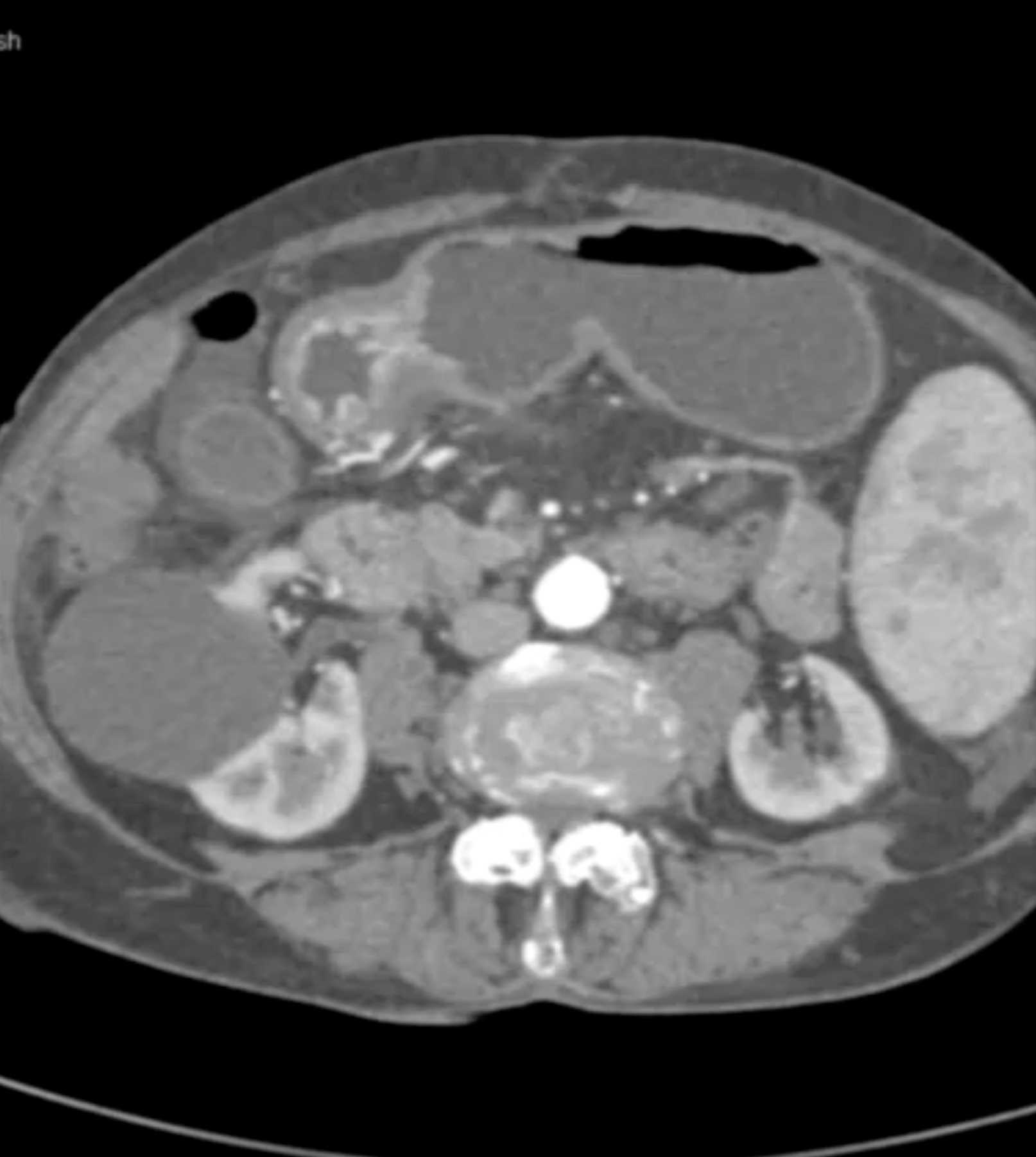 Watermelon Stomach (Gastric Antral Vascular Ectasis) - CTisus CT Scan