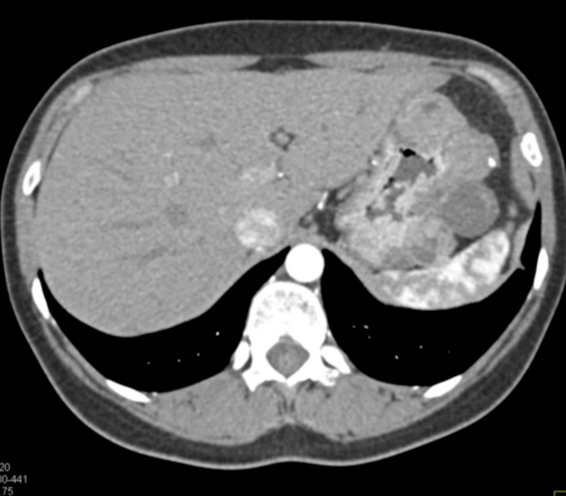 Multiple Gastric GIST Tumors with Spread to Nodes (Carney-Stratakis Syndrome) - CTisus CT Scan