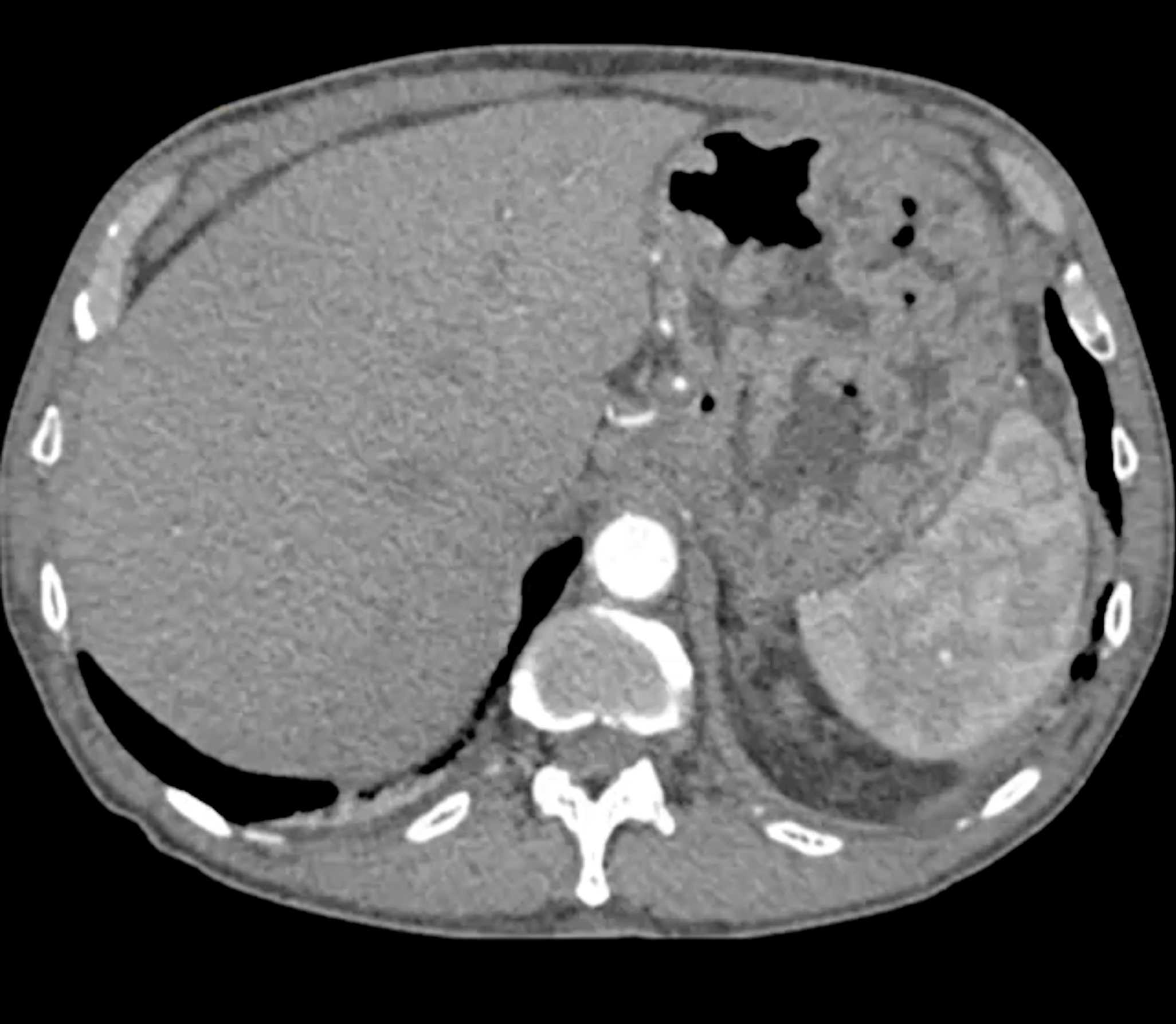 Chemical Gastritis due to NSAIDs - CTisus CT Scan