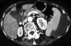 Splenic Laceration With Bleed - CTisus CT Scan