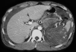 Splenic Rupture - CTisus CT Scan