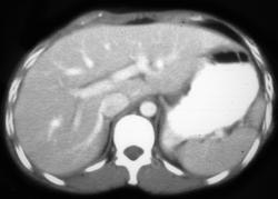 Splenic Laceration - CTisus CT Scan