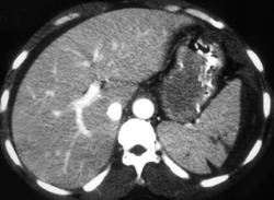 Splenic Laceration - CTisus CT Scan