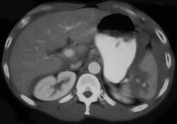 Splenic Laceration - CTisus CT Scan