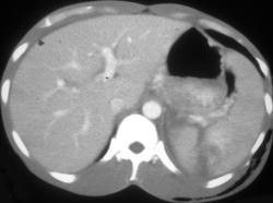 Splenic Laceration - CTisus CT Scan