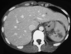 Splenic Laceration - CTisus CT Scan