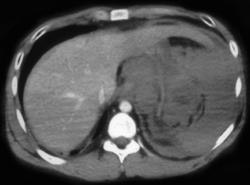 Ruptured Spleen - CTisus CT Scan