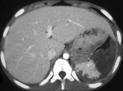 Splenic Laceration With Infarction - CTisus CT Scan