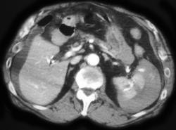 Splenic Laceration - CTisus CT Scan