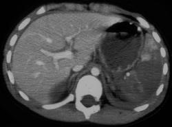 Injury to Splenic and Renal Artery-non Function of Left Kidney - CTisus CT Scan