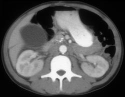 Subtle Hepatic Laceration - CTisus CT Scan