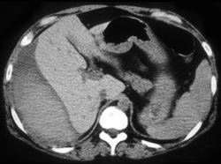 Subcapsular Hematoma - CTisus CT Scan