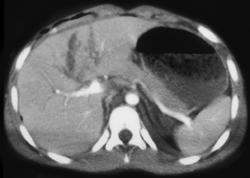 Hepatic Laceration - CTisus CT Scan