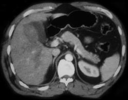 Hepatic Trauma - CTisus CT Scan