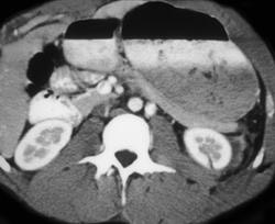 Renal Laceration - CTisus CT Scan