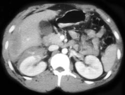 Renal Cysts - CTisus CT Scan