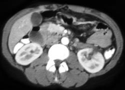 Renal Laceration - CTisus CT Scan